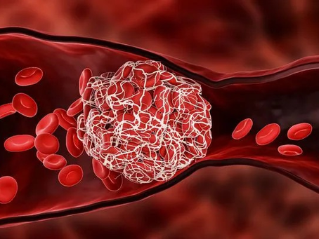 Việt Nam thuộc nhóm nước có tỷ lệ đột quỵ cao nhất Đông Nam Á