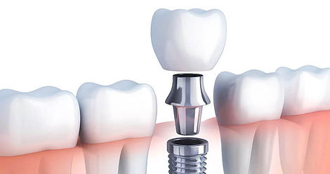 Cement retained implant crowns.jpg