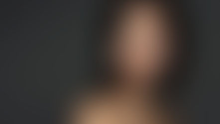 How much is Botox in North Miami Beach, FL?