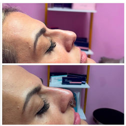 Before and After picture gallary injectable lip fillers botox dysport in Hallandale Beach