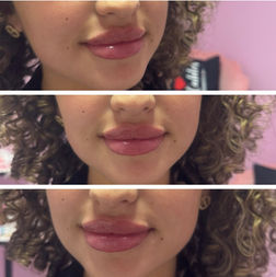 Before and After picture gallary injectable lip fillers botox dysport in Hallandale Beach