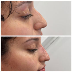 Before and After picture gallary injectable lip fillers botox dysport in Hallandale Beach