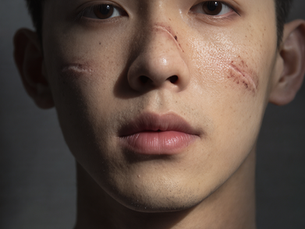 Peau [Peau avec petites plaies en cours de cicatrisation, ton éducatif.]