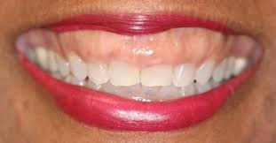 Gummy+Smile-1920w.jpeg