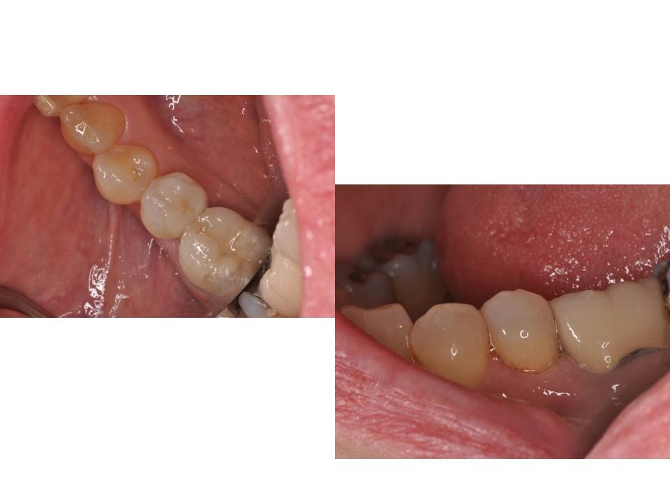 How to Use Multilink Automix, a SelfEtch Resin Cement