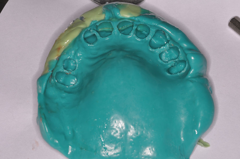 PVS Denture Impressions With Teeth Present