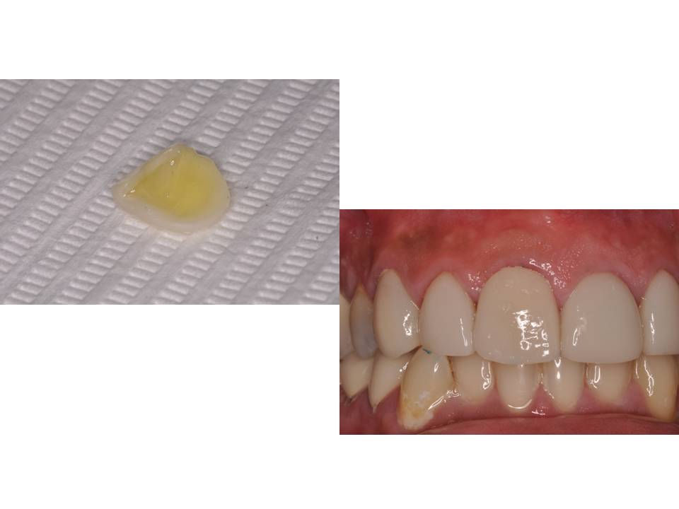 How to use Variolink Veneer, a TotalEtch Resin Cement