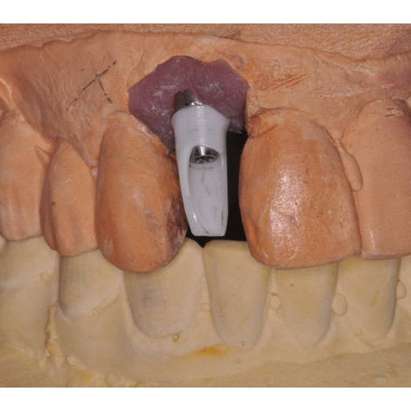 When Should We Use a Zirconia Implant Abutment?