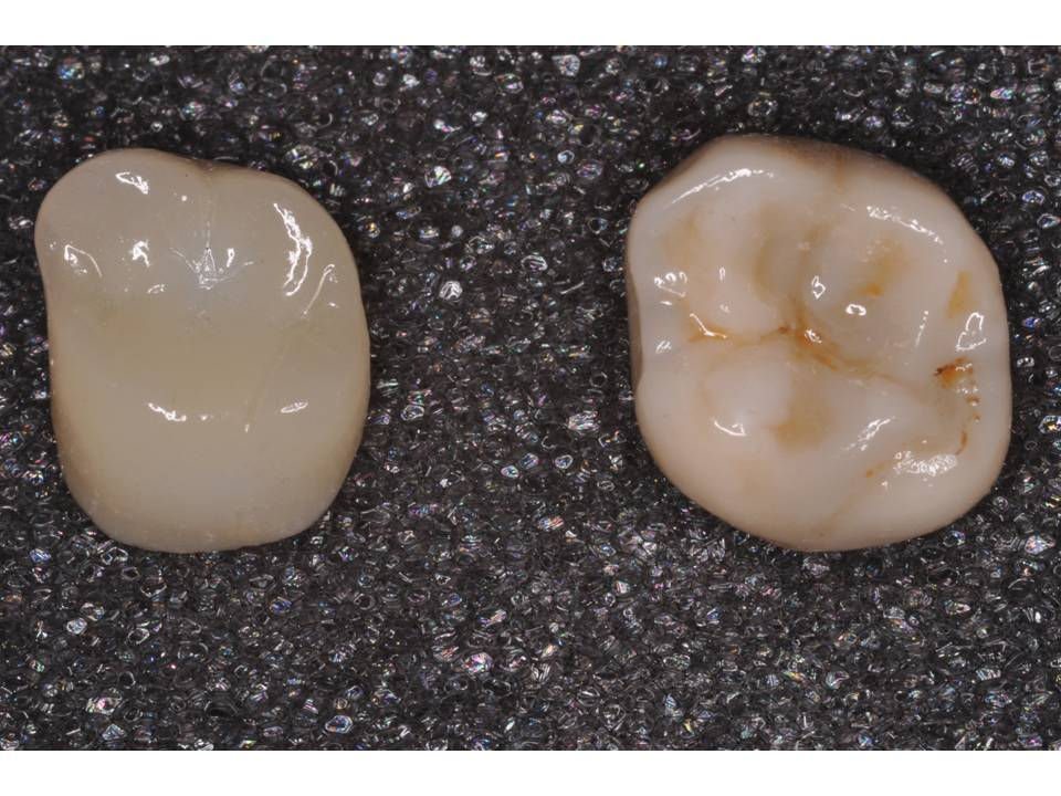 Lithium Disilicate or Zirconia?