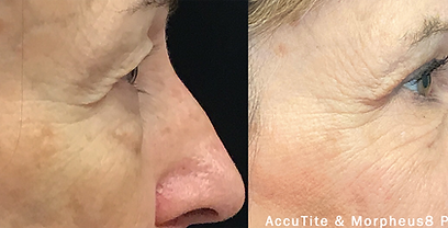 accutite-morpheus-prime-before-after-dr-s-paul-preview-3_edited.png
