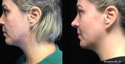 JM_Morphues8_Before_After_TM-LeftSideJawline.jpg
