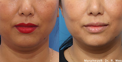 morpheus-8-before-after-dr-r-westreich-preview-1.jpg