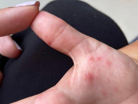 Confirman brote de virus Coxsackie en preescolares de Acapulco: suman 40 casos