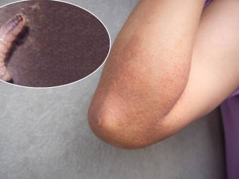 Confirman en Belice primer caso humano de gusano barrenador