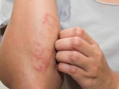 Reportan 51 casos de lepra en México durante 2025