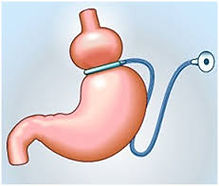 Gastric Band