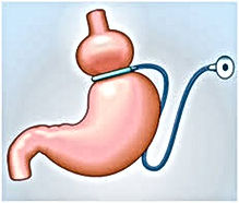 Gastric Band