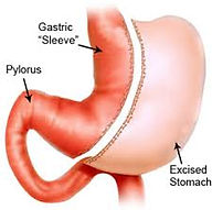 Sleeve Gastrectomy