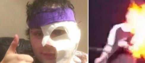 Michael Clifford dos 5 Seconds of Summer queimou o rosto durante o show