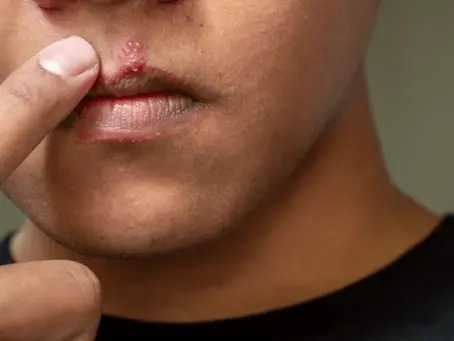 Man lip with cold sore