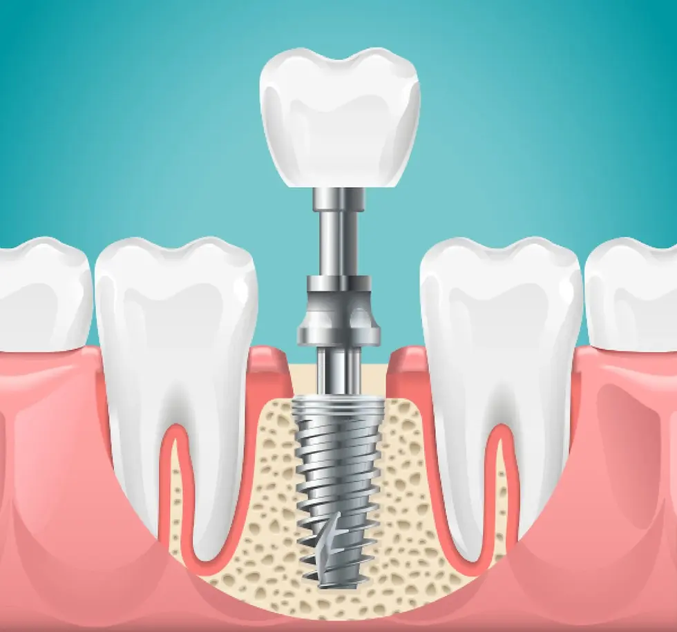 Illustration of a dental implant procedure, showcasing a tooth implant installed in a jawbone between healthy teeth, highlighting the screw-like implant structure and the new porcelain crown.