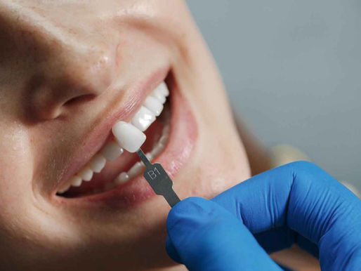A person smiling with a tooth shade guide held by a gloved hand against their teeth. The guide is labeled "B1" and suggests a dental setting.