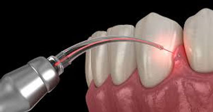LASER RCT TREATMENT - Single visit root canal treatment
