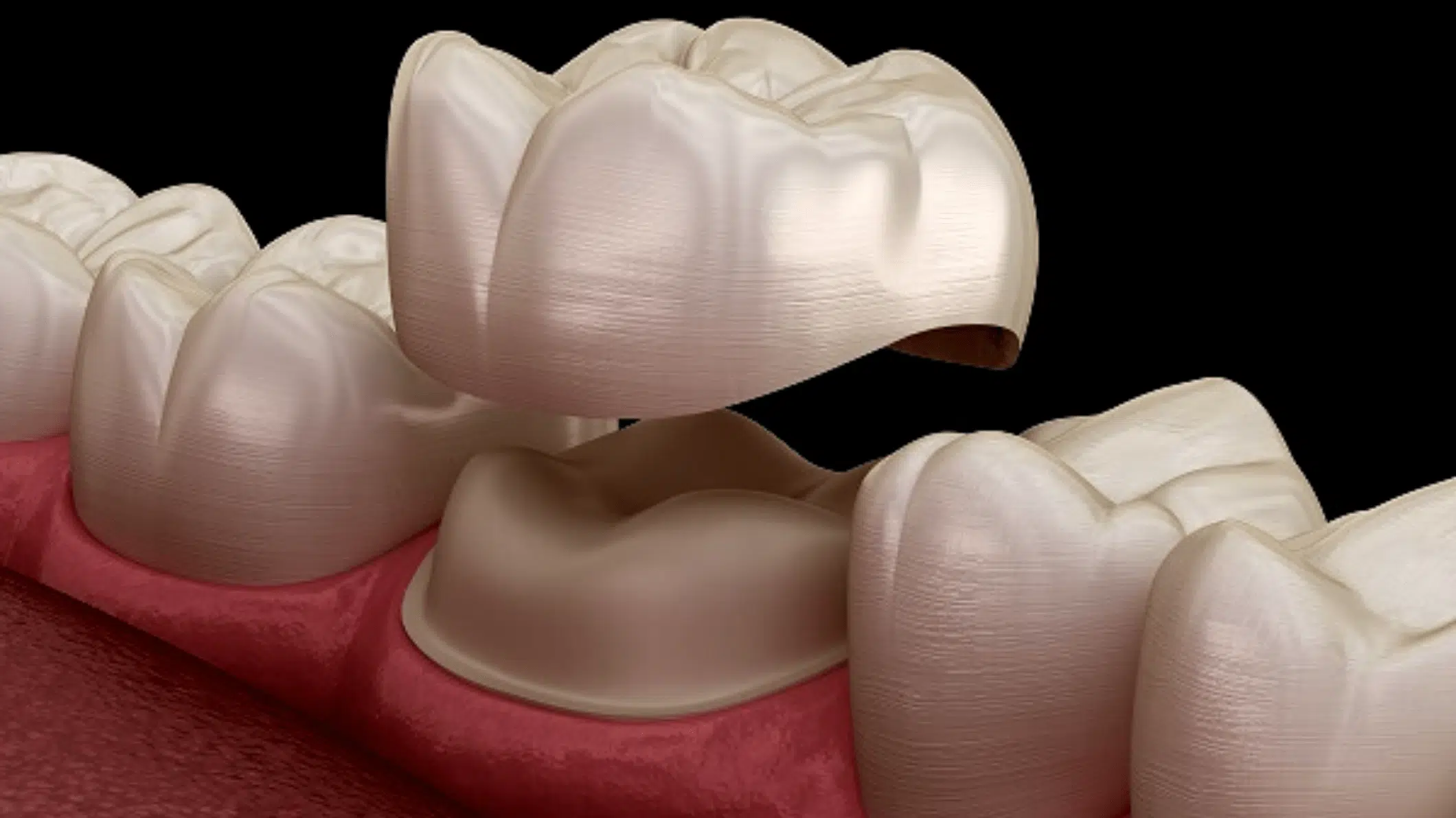 Dental Crowns Zircon or Emax