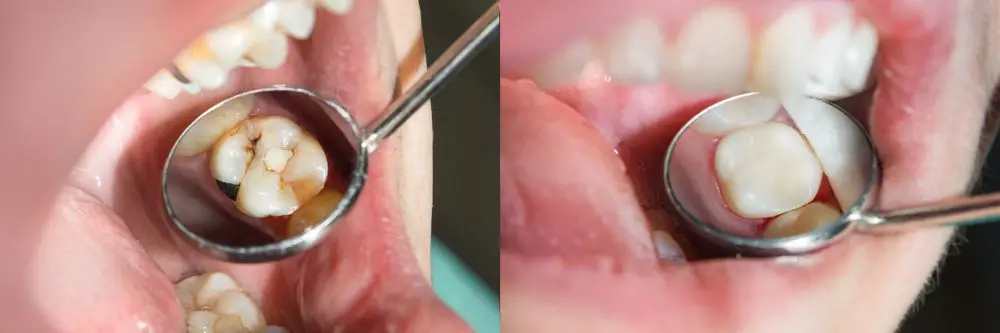 Dental Filling for broken Tooth