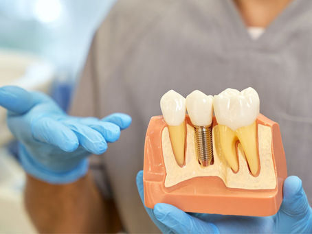 Understanding the Cost of Dental Implants: Factors to Consider