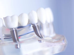 The Benefits of Dental Implants for Overall Oral Health
