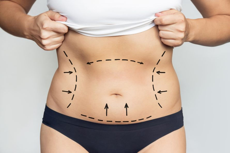 closeup-womans-belly-with-excess-fat-with-marking-her-body-liposuction-plastic-surgery.jpg