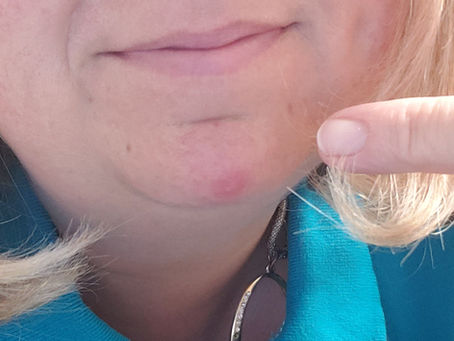 When a Pimple Rears its Ugly Head - Taking One for the Team