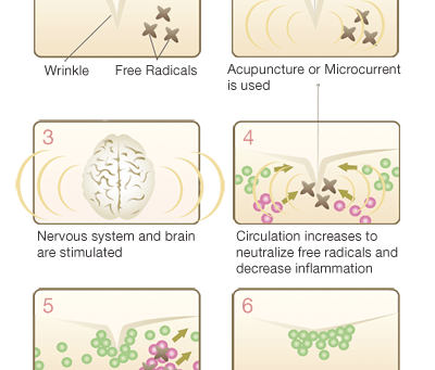 Cosmetic Acupuncture