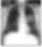lung cancer