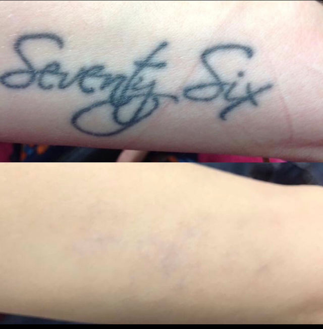 Tattoo removal