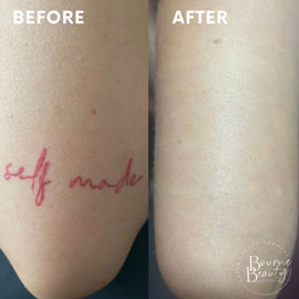 "Tattoo removal near me"