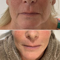 Jaw tightening results