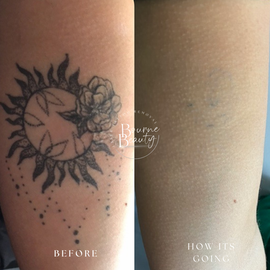 Laser Tattoo Removal