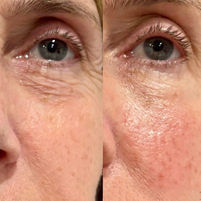 Under eye treatment
