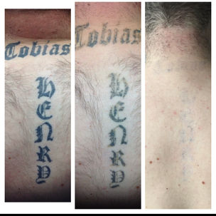 tattoo removal results