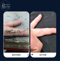 "laser tattoo removal  results near me"