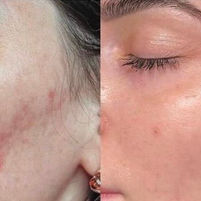 Acne scar removal near me