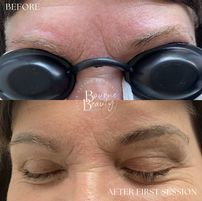 Eyebrow tattoo removal session results