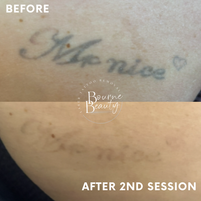 "laser tattoo removal"