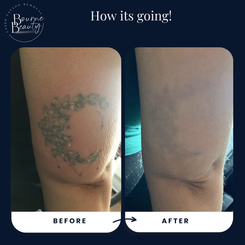 Tattoo removal