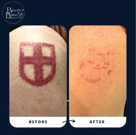 "Tattoo removal Process"