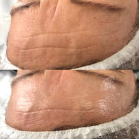 Microneedling near me