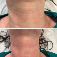Microneedling near me