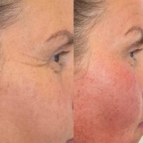 Fine line and wrinkles removal